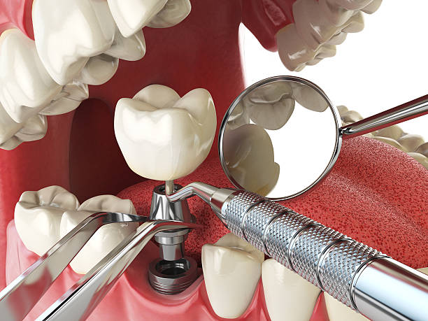 Best Emergency Tooth Extraction in Waveland, MS